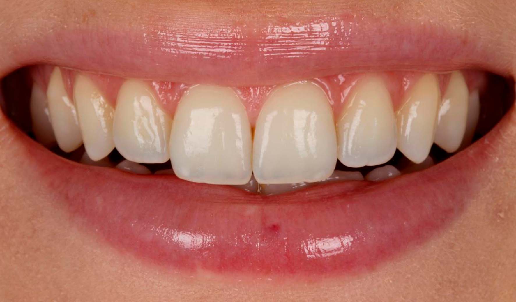 Leia mais sobre o artigo Qual a diferença entre Lentes de Contato Dental e Facetas de Porcelana?